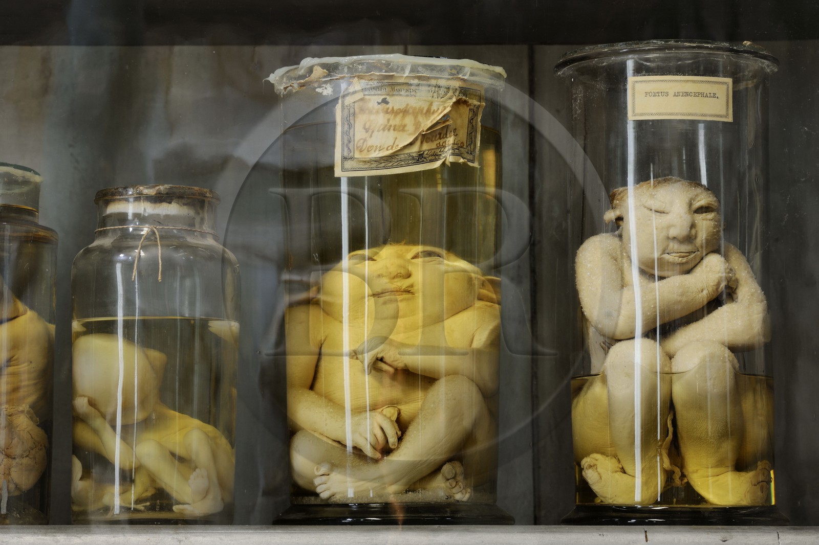 France, Herault, Montpellier, historical center, Medecine University, Anatomy Museum, fetus of the teratology collection which is the scientific study of congenital malformations